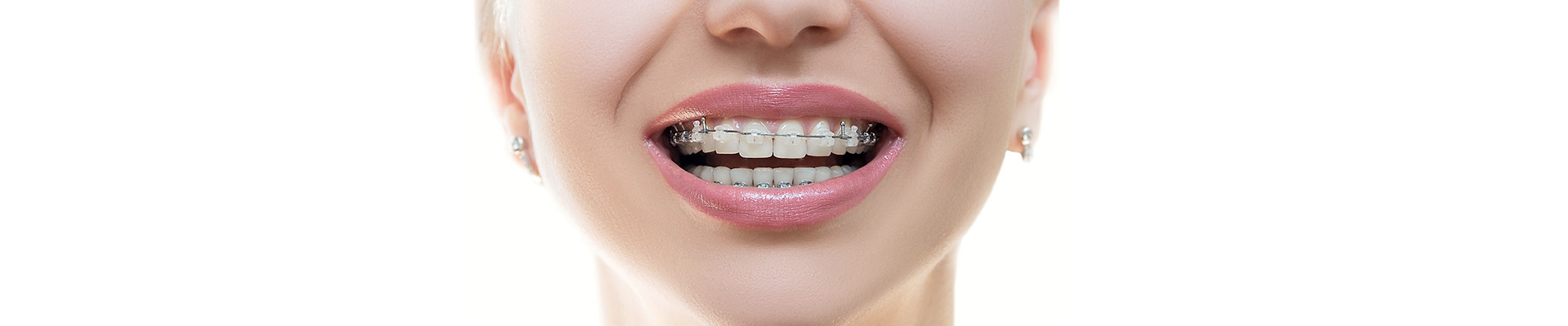 Ortodonti Tedavileri Ortodonti Tedavileri